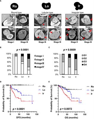 Complexity in radiological morphology predicts worse prognosis and is associated with an increase in proteasome component levels in clear cell renal cell carcinoma